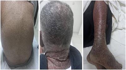 A posteriori diagnosis of DRESS syndrome induced by diazoxide in a patient with an insulinoma: a case report and review of the literature